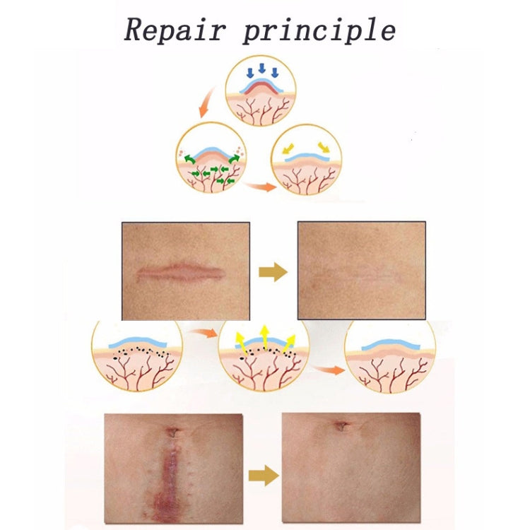 Organic silicone Gel Scar Therapy Patch be Washed and Reused