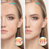 XPREEN XPRE052 Wireless Rechargeable Light Acne Treatment Device Home Acne Clearing Eraser with Blue Light and Red Light, XPRE052